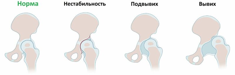 Дисплазия (недоразвитие) тазобедренных суставов – врожденное заболевание